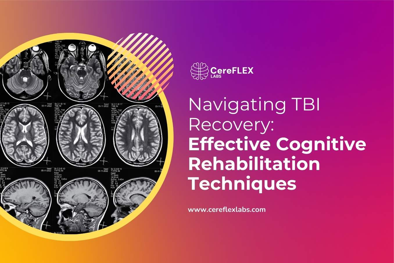 Comprehensive Guide to Cognitive Rehabilitation After TBI